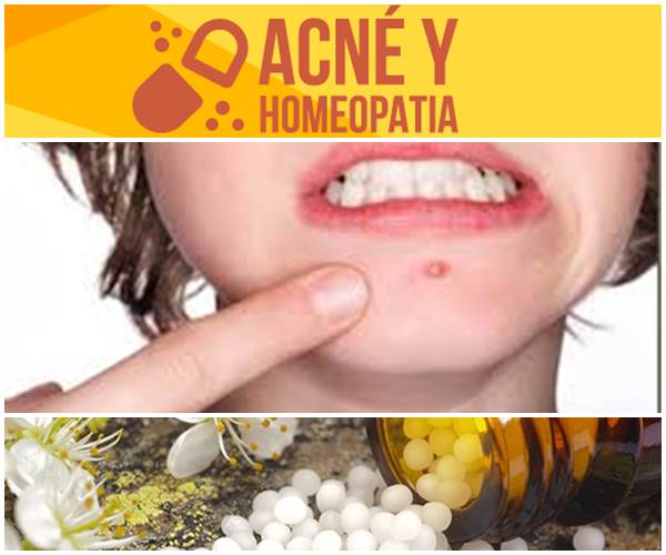 homeopatia para el acné
