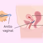 anillo-anticonceptivo-vaginal-todo-sobre-su-uso-y-efectividad