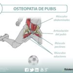 tratamiento-y-prevencion-de-la-osteopatia-de-pubis-en-deportistas